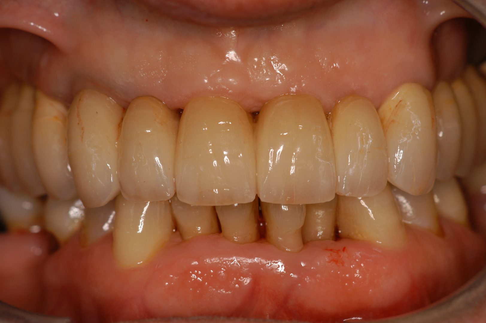 Corone Metallo Ceramica DentalProgress